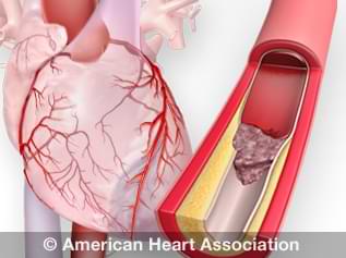 view interactive animation of a heart attack